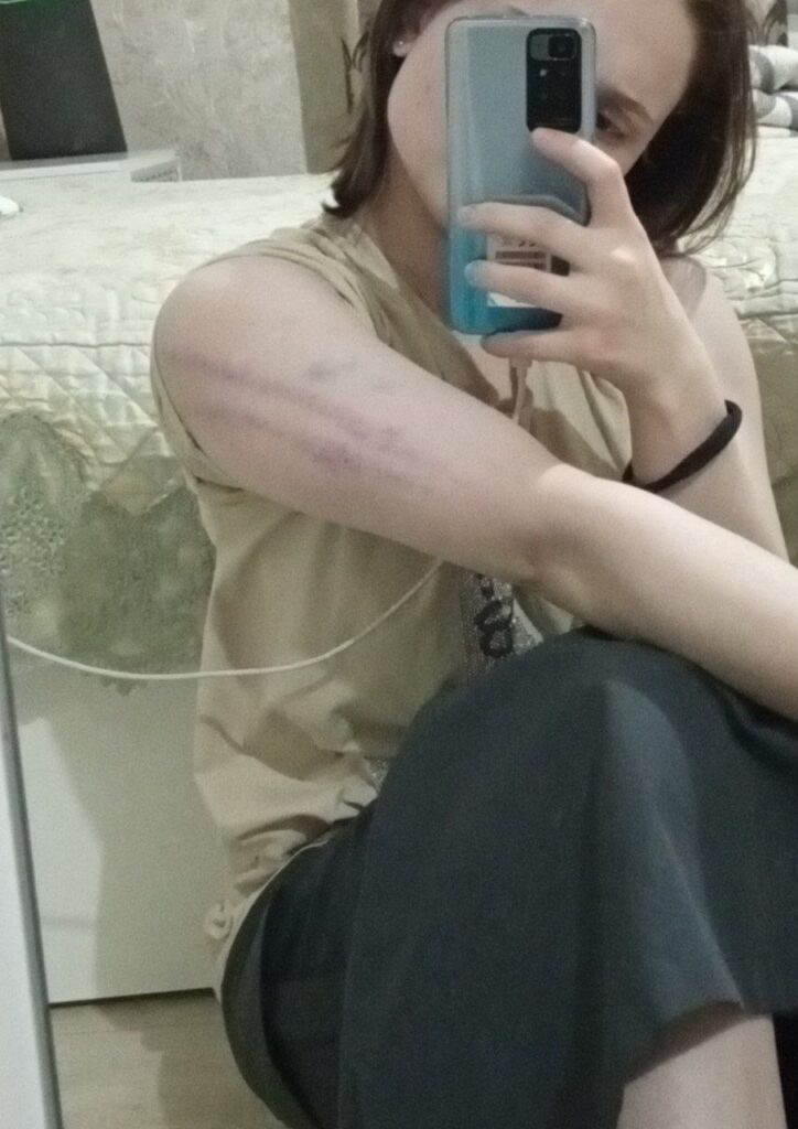 Фото побоев Айшат Баймурадовой