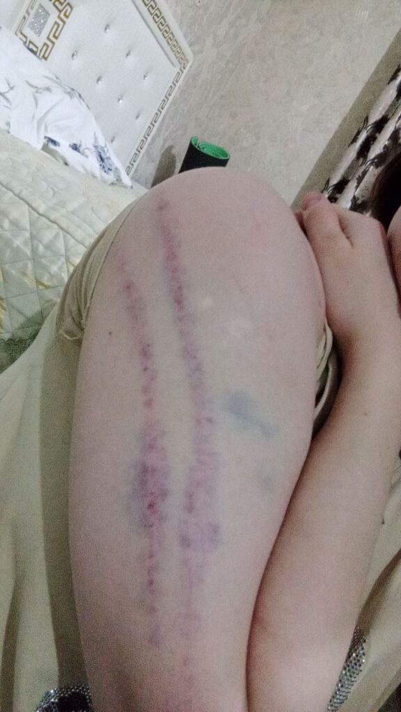 Фото побоев Айшат Баймурадовой